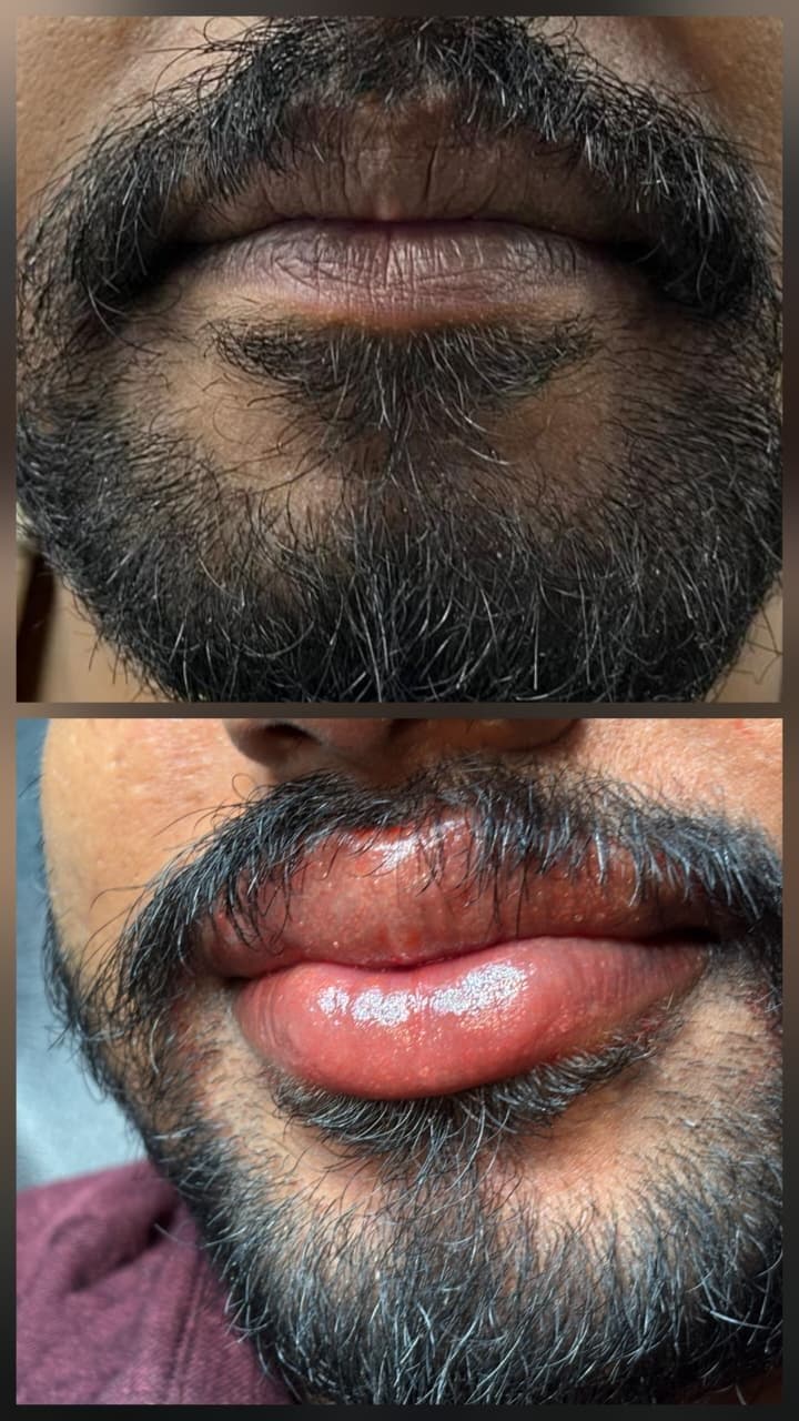 Lip neutralization for men, before and after