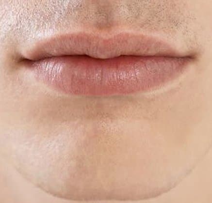 Lip Neutralization for Men procedure at Rebornurself